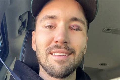 Jeff Wittek, 32, in the hospital after he shattered his skull in nine places and nearly lost his eye in a YouTube stunt gone awry. . Jeff wittek eye